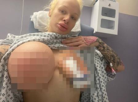 Após implante de silicone, seio de atriz pornô explode durante o banho 
