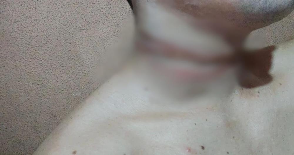 Motociclista que teve pescoço ferido por fios diz que vai processar Amazonas Energia