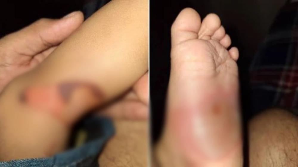 Bebê é torturado com queimaduras e tem clavícula quebrada; pais são suspeitos