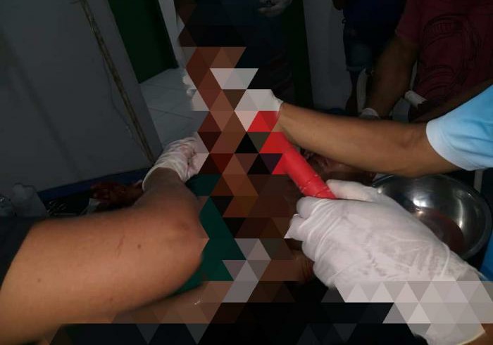 Homem fica gravemente ferido ao levar terçadadas na cabeça 